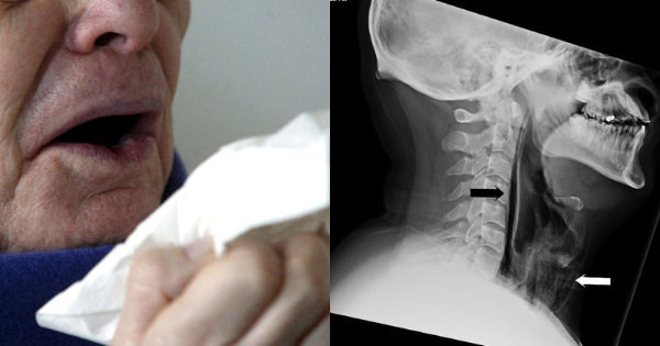 34 Year Old Man Ruptures His Throat Because He Was Trying To Hold In A