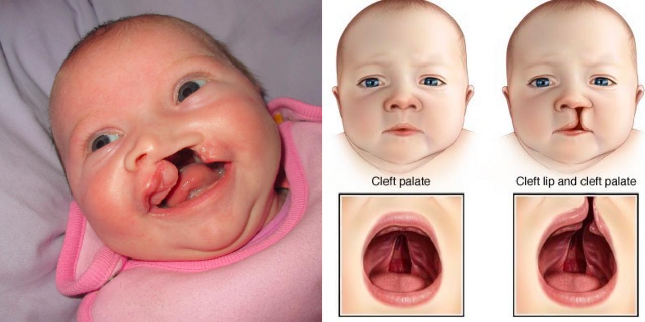 Ini 3 Faktor Utama Yang Menyebabkan Bayi Sumbing Bibir 