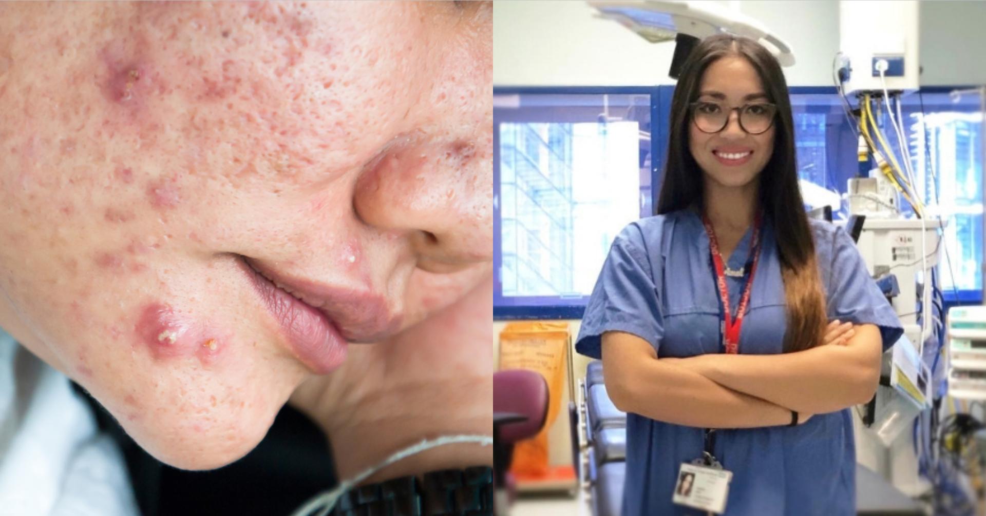 Jerawat Di Pipi Tanda Pori Tersumbat? Dr Amalina Bidas Dakwaan Jerawat Tanda Penyakit