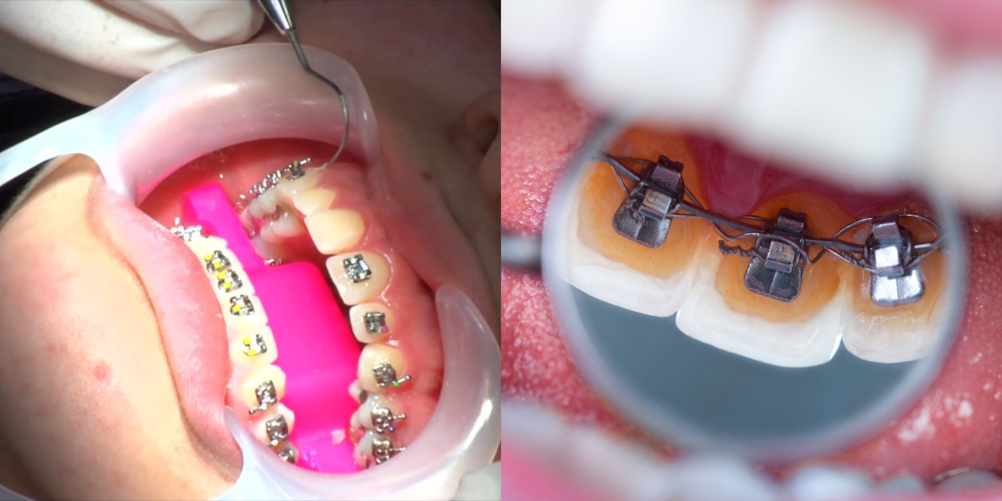 Akibat 'Fake Braces', Anda Boleh Terdedah Kepada Kanser 