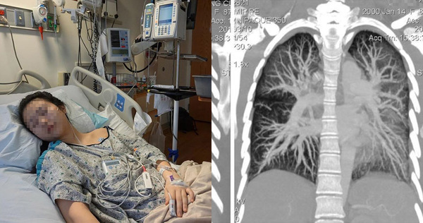 19-Year-Old Shares Photos Of Her Damaged Lungs As Plea To Others To ...