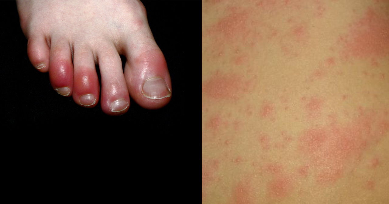 'COVID-Toe' And Rashes May Be Latest Coronavirus Symptoms