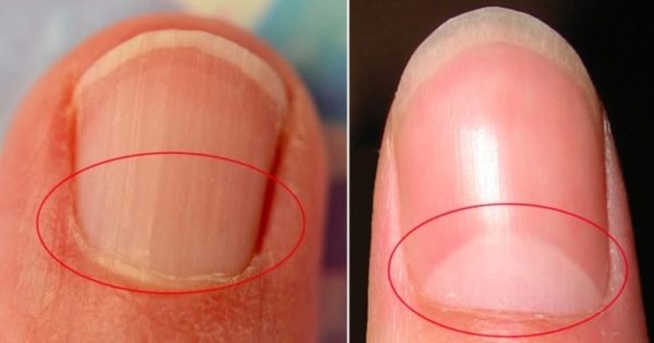 Here's What Your Nails Say About Your Health