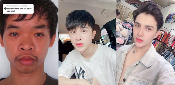 26-Year-Old Spends RM70,000 On Plastic Surgeries After He Was Ridiculed ...