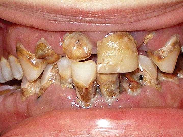 crack addiction teeth