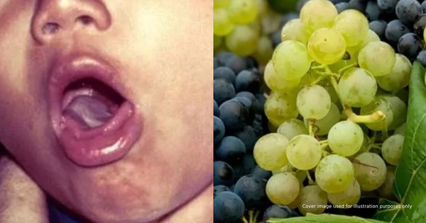 2-Year-Old Melaka Girl Dies After Choking On A Grape - Unintentional Muscadine Grape Pet Choking