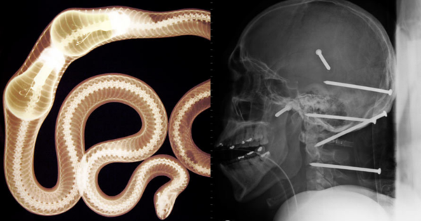 [PHOTOS] 9 Most Unexpected Things to Find In Your Body At An X-Ray
