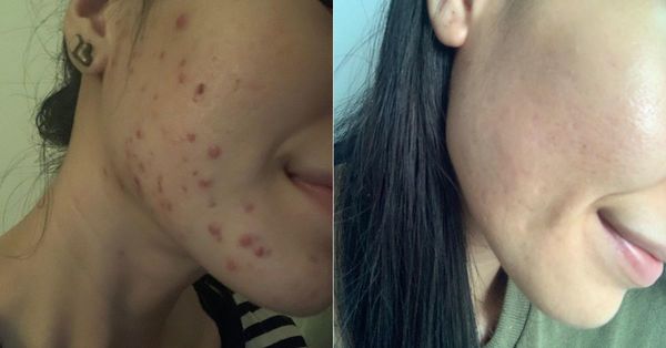 A before and after of my bare face, which Dr Chew helped treat through a combination of antibiotics, facials, and PicoSure laser therapy.