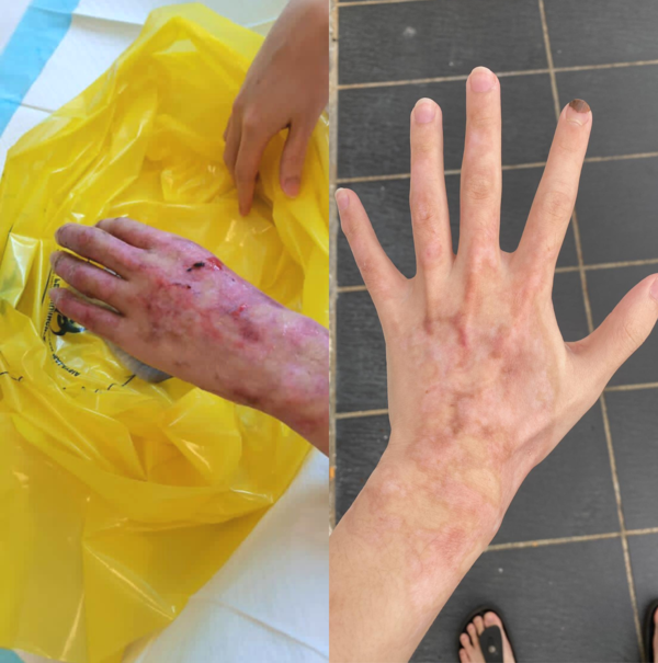 Jason's injured left hand when receiving treatment at the hospital in September 2022 (left) and his hand after recovery (right) on 11 January 2023.