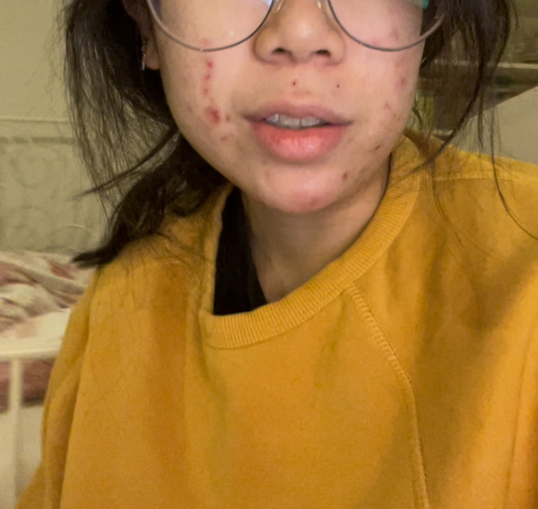 Lei's acne scars before her skin began to heal.