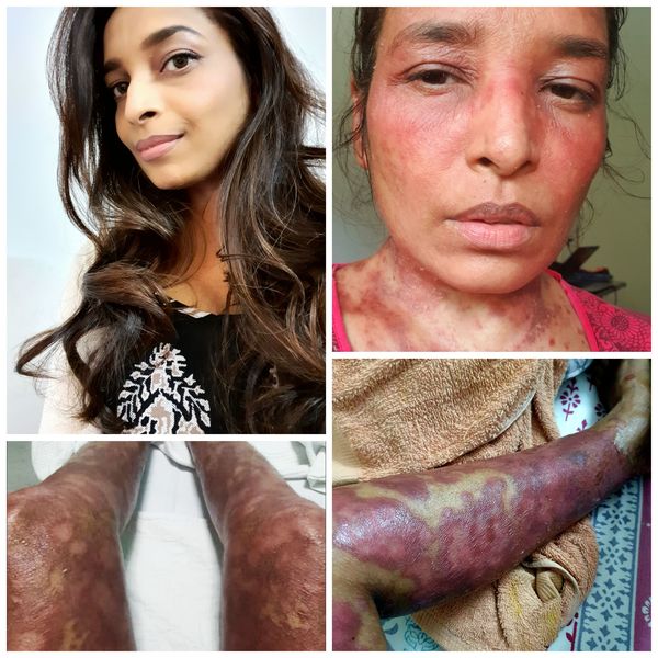 Some of the worst effects of psoriasis on Sofia's body.