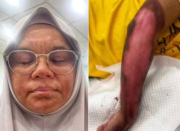 Noraini Abdullah, 53, suffered facial burns as a result of the incident, while her son, Arif Fauzan, 26, suffered burns on his arm and body.