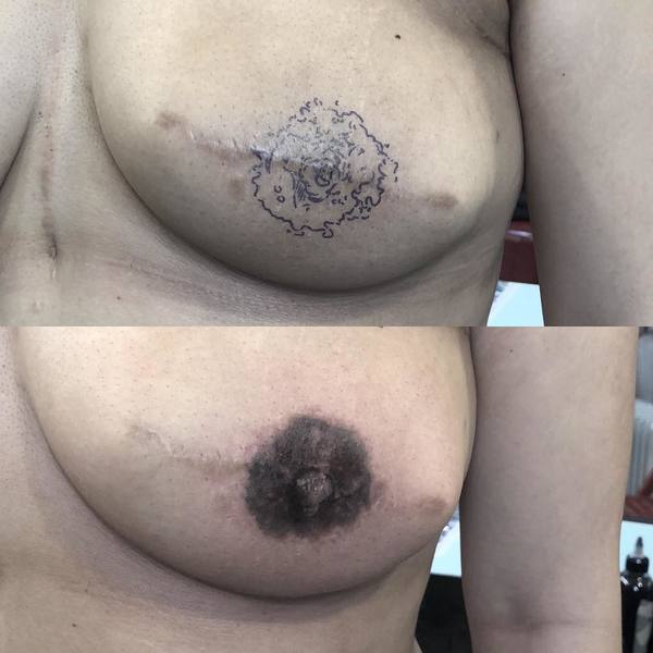 An areola tattoo Andrew did on a breast cancer resection client.