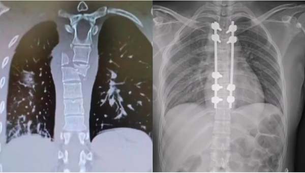 Hong's X-rays before and after the corrective surgery.