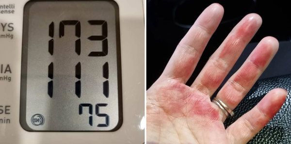 Yeoh shared photos of her blood pressure readings (left) and her eczema flare-up (right).