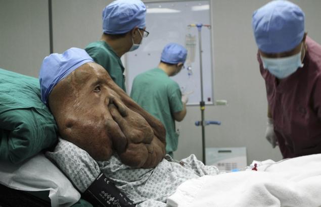 'Elephant Man' Has A Total Of 19Kgs Of Tumour Removed From His Face But