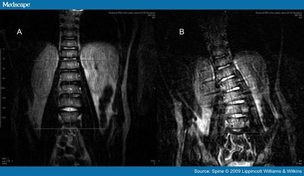 How a backpack can cause an asymmetric lumbar spine.