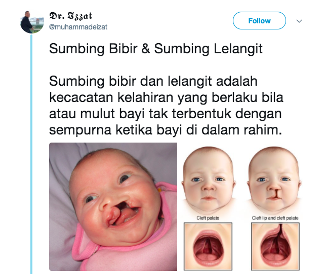 Punca bayi sumbing