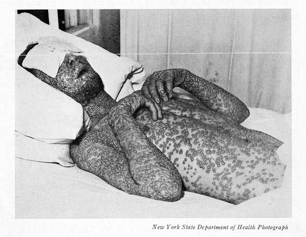 Antara pesakit Smallpox yang sempat direkodkan dalam sejarah.