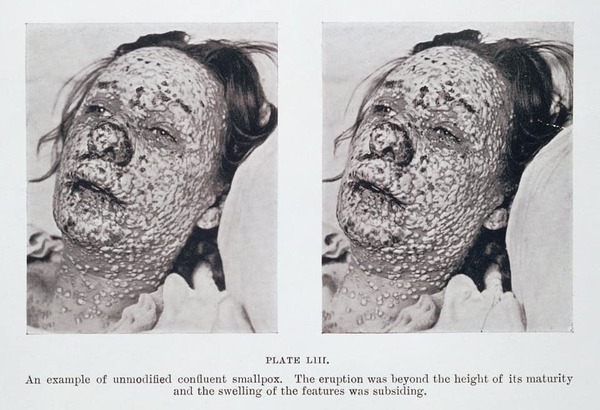 Parut yang diberikan oleh Smallpox sangat mengerikan.