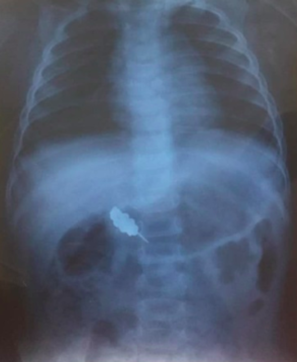 The baby's X-ray scan.