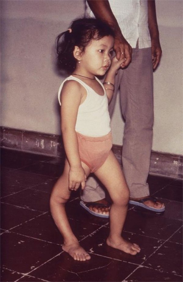 A child with a permanent deformity of her right leg caused by poliovirus infection.