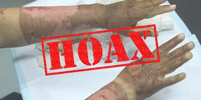 hoax hand sanitizer membakar tangan