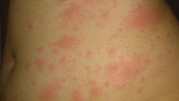 Get Covid Symptoms Rash Skin Images