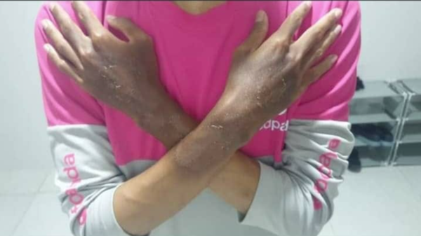 Photo showing Mohamad suffering from sunburn on his hands.