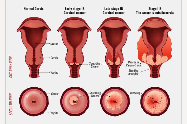 The normal cervix (far left) and different stages of cervical cancer.