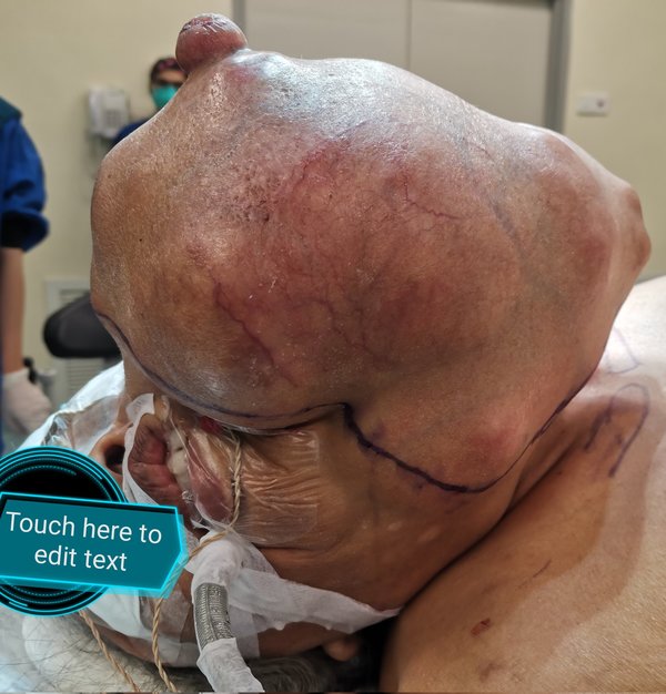 Before the procedure, the tumour was 20cm x 30cm in size after growing in the patient's neck for almost eight years. The patient gave his permission for his condition and pictures of his surgery to be shared online for learning purposes.